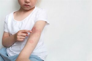 Read more about the article Psorijaza kod Djece: Razumijevanje, Simptomi i Siguran Tretman