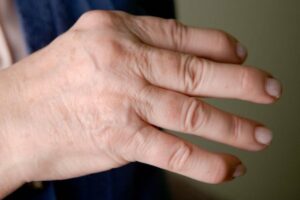 Read more about the article Artritis Psorijaza: Detaljni Vodič o Simptomima, Tipovima, Dijagnozi i Modernom Liječenju Psorijatičnog Artritisa