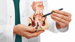 Read more about the article hemoroidi simptomi – Prepoznavanje i Razumijevanje Tegoba