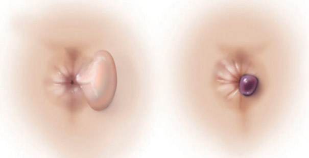 koliko traju hemoroidi