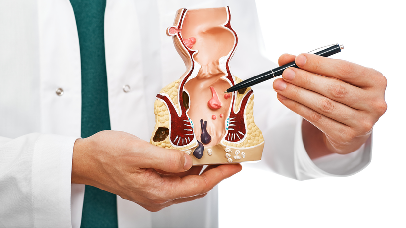 hemoroidi simptomi – Prepoznavanje i Razumijevanje Tegoba