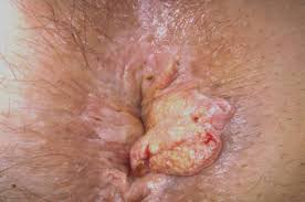 Slike vanjskih hemoroida