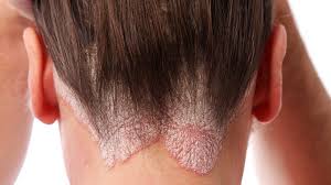 Read more about the article Psorijaza Skalpa (psorijaza na glavi ): Sveobuhvatni Vodič i Strategije Liječenja