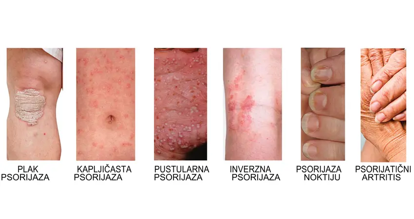 psorijaza simptomi