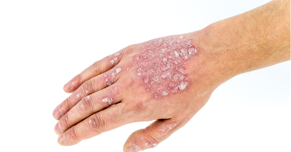 You are currently viewing Psorijaza Ruku i Dlanova (Psoriasis Palmaris): Klinička Slika i Savremena Terapija