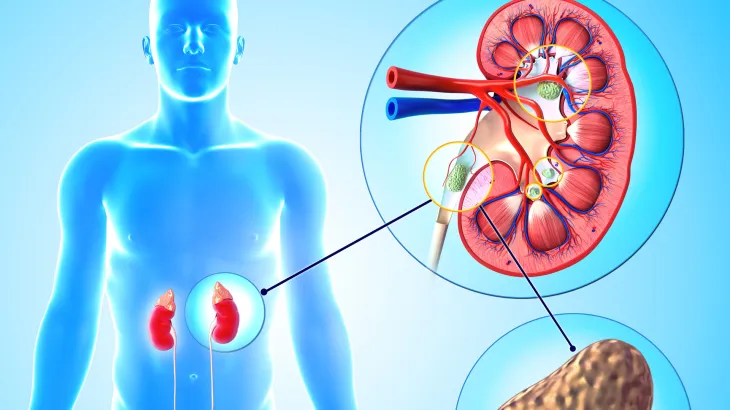 You are currently viewing Bubrezi Kamenac: Uzroci, Simptomi, Dijagnoza i Liječenje