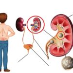 Bijeli bubrezi – Kompletan vodič o uzrocima, simptomima i liječenju