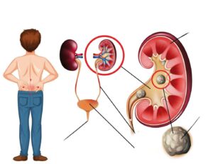 Read more about the article Bijeli bubrezi – Kompletan vodič o uzrocima, simptomima i liječenju