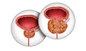 Read more about the article Prostate funkcija u tijelu muškarca i najčešći poremećaji