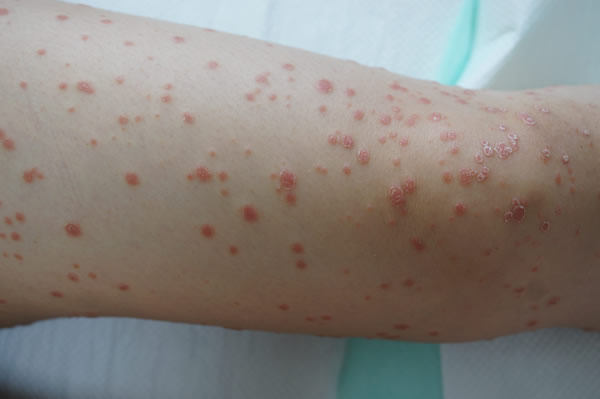 You are currently viewing Kapljična Psorijaza: Potpuni Vodič za Psoriasis Guttata – Simptomi, Uzroci i Efikasno Liječenje