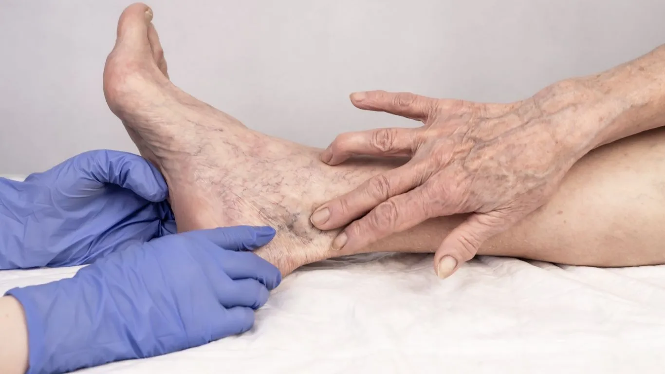 Read more about the article Proširene vene i vježbanje: Kompletan vodič za zdravlje vaših nogu